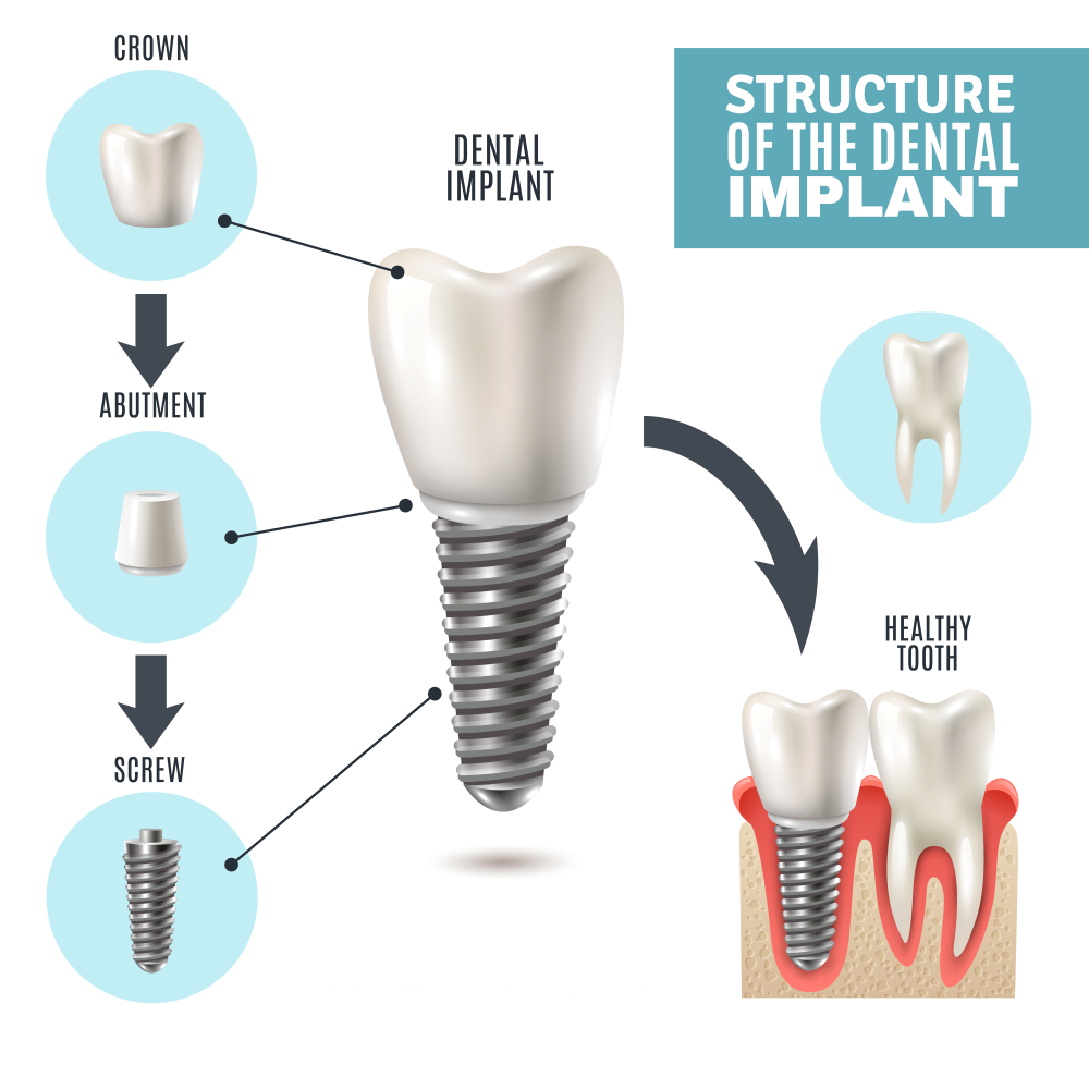 dental implants strucure at vibes clinic in dubai jumirah.jpg